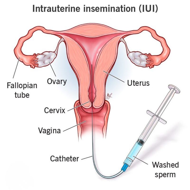 procedure 2